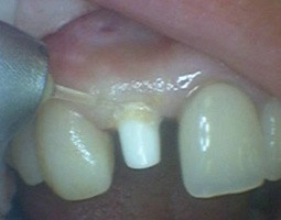 Tooth-Replacement-3