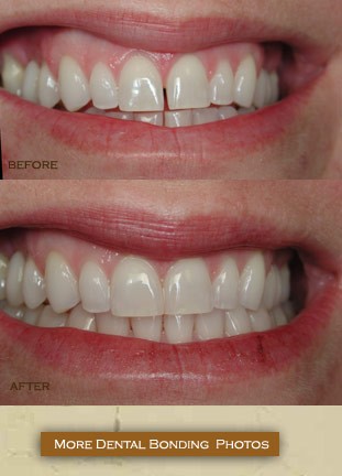 Composite Bonding For Teeth - Dental Treatments