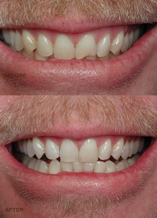 Tooth Filling, Veneers, or Dental Bonding?