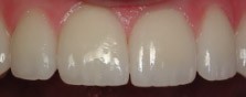 The porcelain veneers fitted