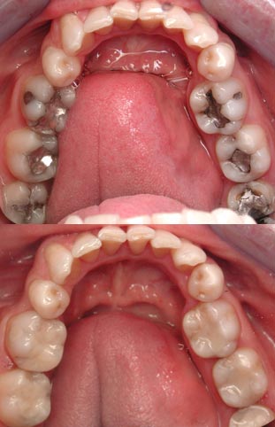 Tooth-colored fillings - David Eshom, DDS in San Diego